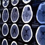 Brain Bleed - Brain Scan