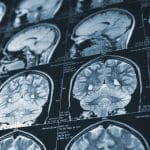Traumatic Brain Injuries vs. Concussions