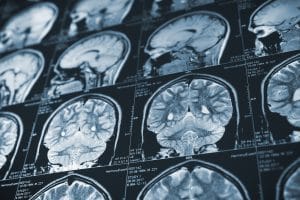 What You Need to Know About Traumatic Brain Injury 