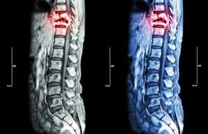 Complications Arising from Paralysis Due to Spinal Cord Injury (SCI)