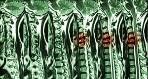 Spinal Cord Compression Can Lead to Paralysis
