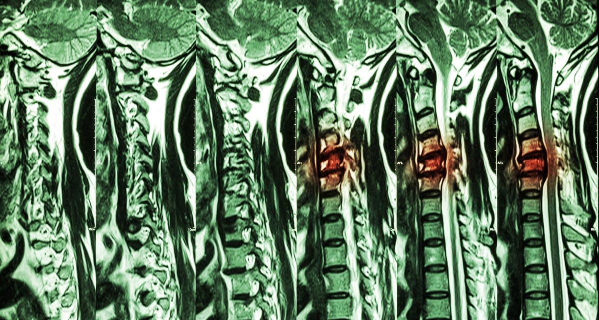 Spinal Cord Compression Can Lead to Paralysis McNicholas & McNicholas