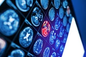 When Brain Bleeds Are Caused by Car Accidents