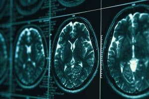 Traumatic Brain Injuries in Los Angeles