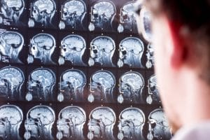 Can a Brain Injury Cause Paralysis?