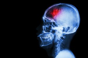 Early Diagnosis in Traumatic Brain Injury Cases