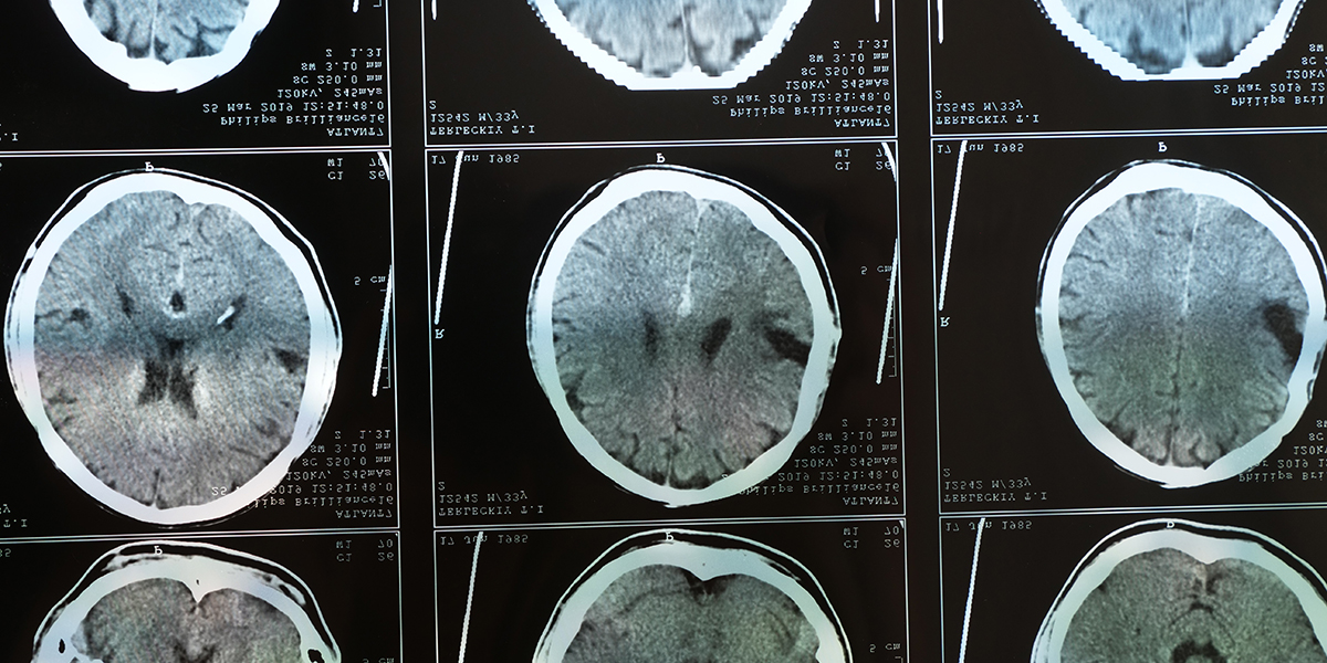 This stock photo shows a magnetic resonance imaging MRI of the brain after traumatic brain injury, showing that the brain is damaged