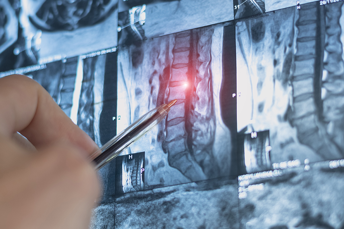 Mri scan of cervical spine hernia. Medical x-ray examining.