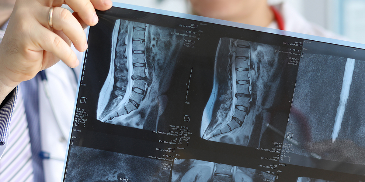 spinal cord injury lawyers in la